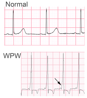 Tristani Lab WPWECP Research Graphic 