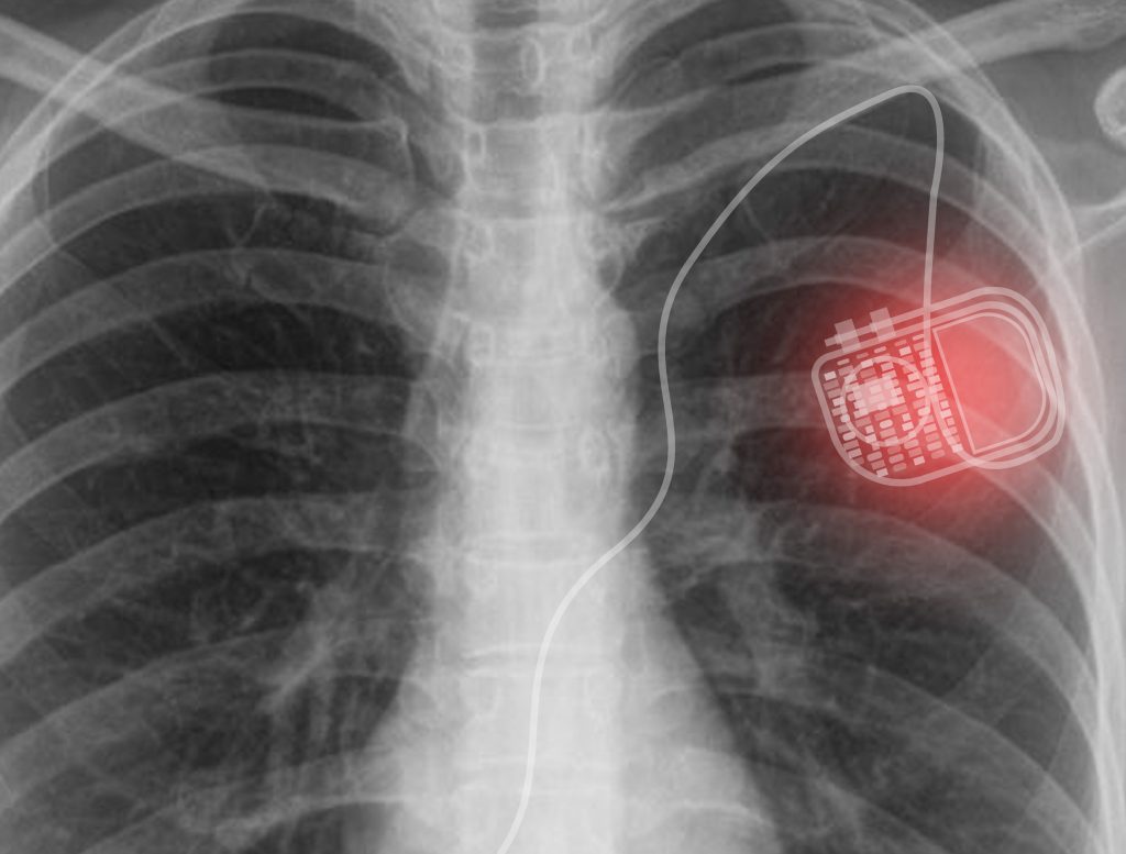 Black and White XRay of Chest with Pacemaker