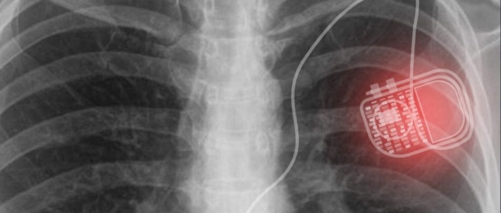 Closeup Image of Pacemaker in Chest