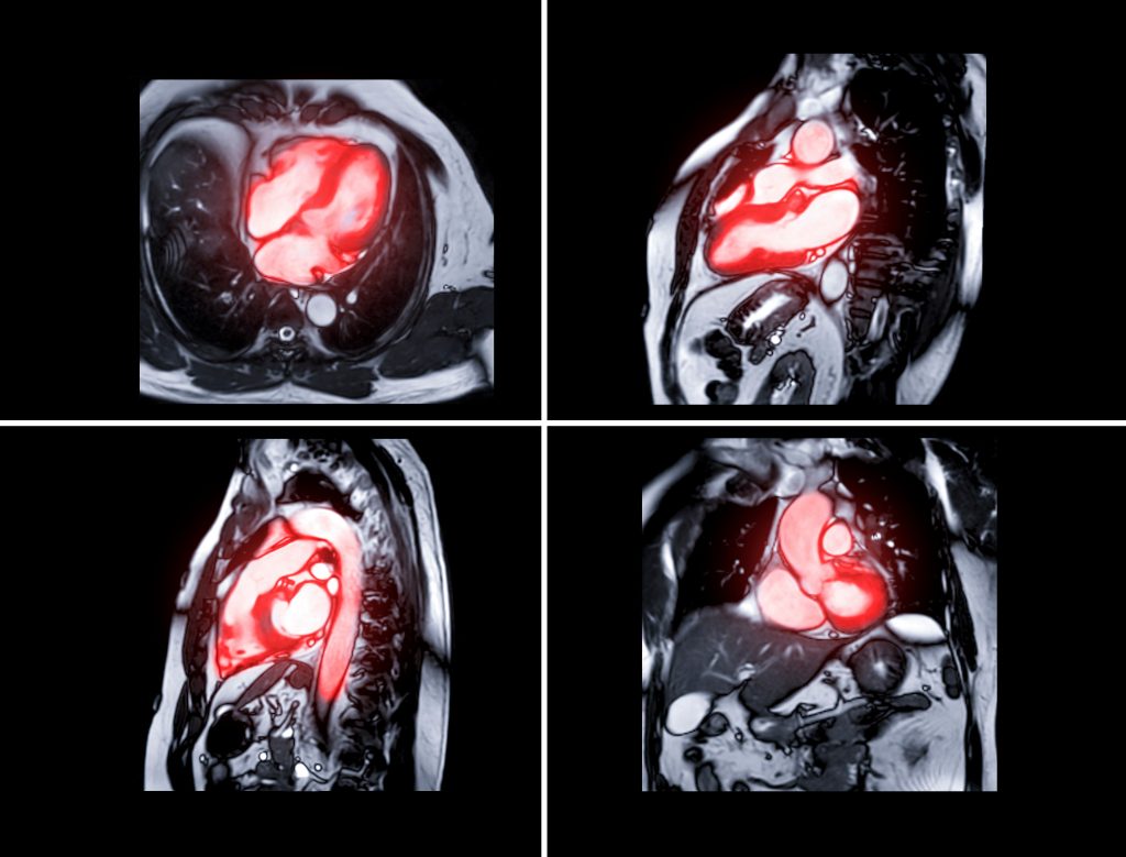 arrhythmia