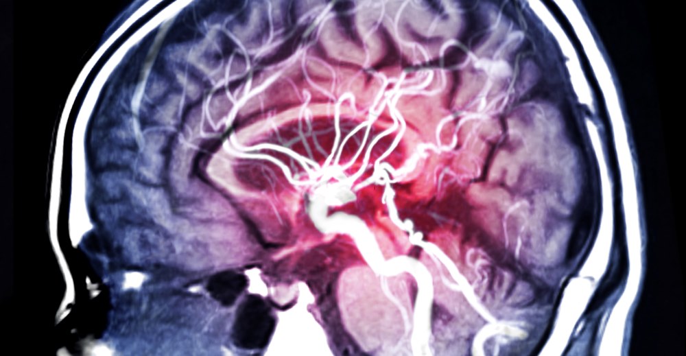 Aneurysm Treatments: From Monitoring to Surgical Interventions