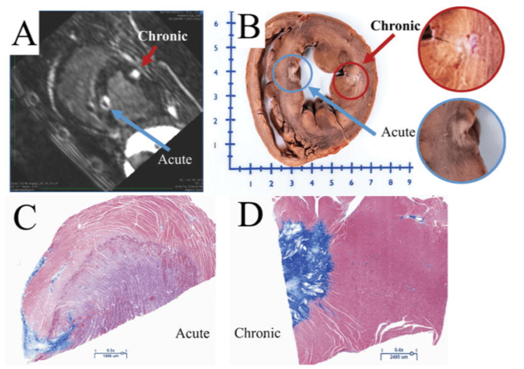 A: MRI and heart dissection highlight acute (blue) and chronic (red) damage. B: Close-ups of each region. C: Microscopic view of acute heart tissue. D: Microscopic view of chronic heart tissue. Blue stains indicate tissue changes.