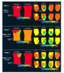 Thermal images showing heat distribution on human torsos, viewed from the front and back. Three plates compare temperature changes before and after treatments at different times and sites, with color scales indicating heat intensity.