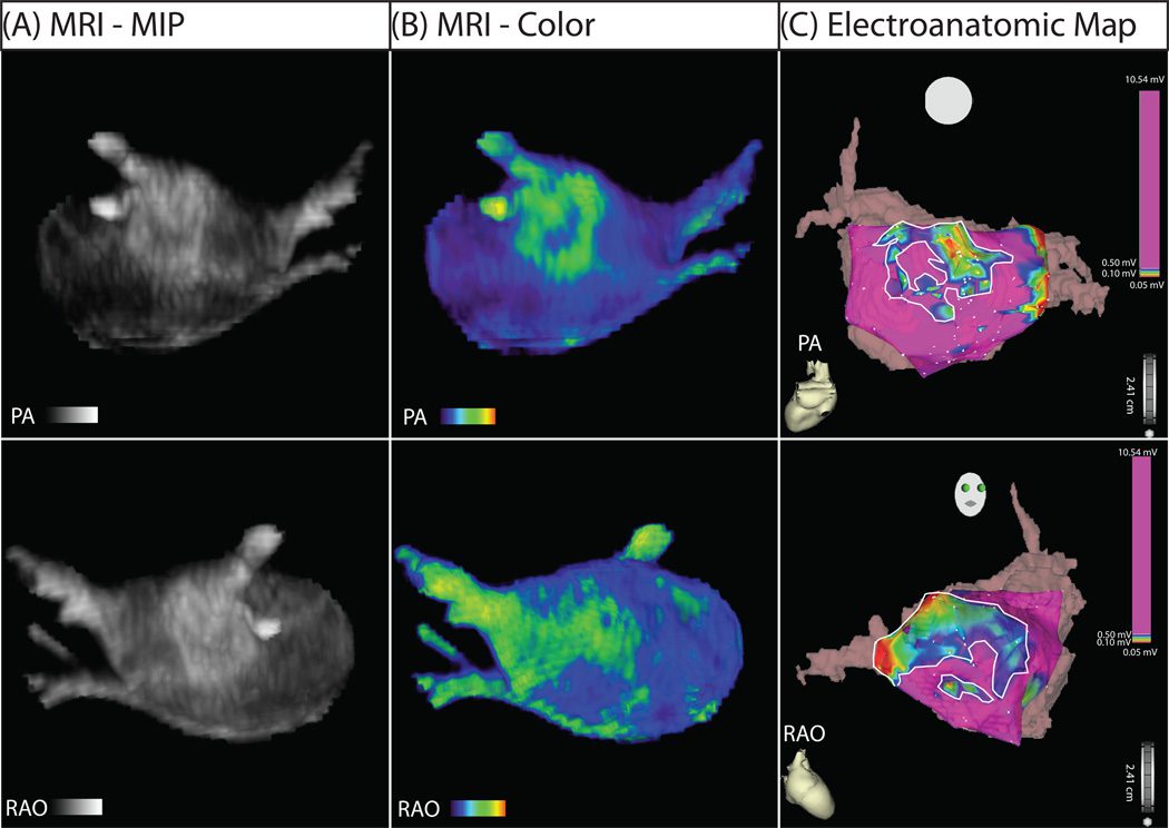Six-panel image shows heart scans: (A) grayscale MRI, (B) MRI with color-coded regions, and (C) electroanatomic map with colored contours, each shown from two angles (PA and RAO). Color scales and small heart icons included.